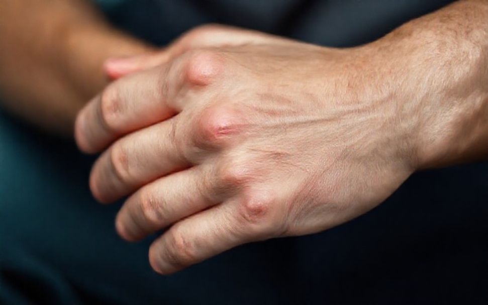 Hoe Jong AZ jeuk en irritatie in één dag verlicht*